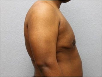 25-34 year old man treated with Male Breast Reduction 3736951