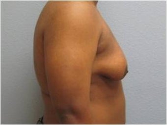 25-34 year old man treated with Male Breast Reduction 3736951