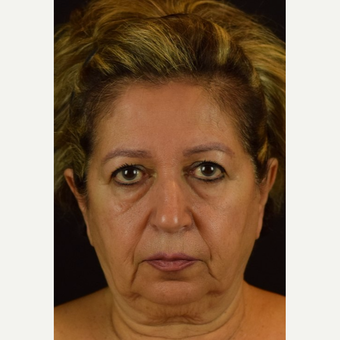 NovaLift - Non-Surgical Rejuvenation with PDO Threads and Microcannula Fillers before 2839338