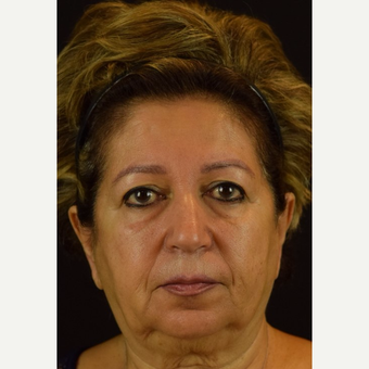 NovaLift - Non-Surgical Rejuvenation with PDO Threads and Microcannula Fillers after 2839338