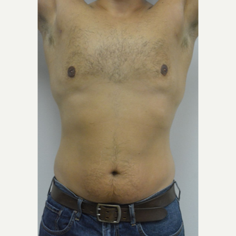 25-34 year old man treated with Male Breast Reduction after 3070573