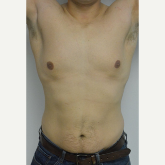 25-34 year old man treated with Male Breast Reduction before 3070573