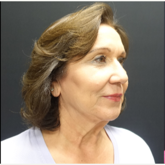 65-74 year old woman treated with SMAS Facelift before 3244971