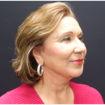 65-74 year old woman treated with SMAS Facelift after 3244971