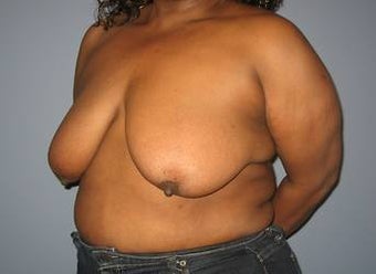 50 Year old Breast Lift/Implant Patient 1355979