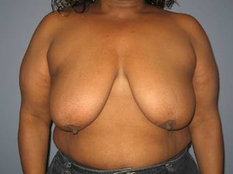 50 Year old Breast Lift/Implant Patient before 1355979