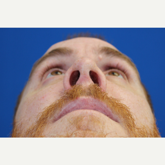 25-34 year old man treated with a Septoplasty and Functional Rhinoplasty after 3215056