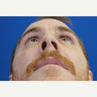 25-34 year old man treated with a Septoplasty and Functional Rhinoplasty before 3215056