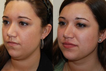 Neck and Jaw-Line Liposuction. Silicone Lip Injections. before 958540