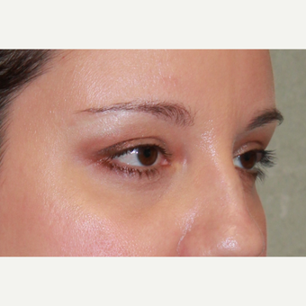 38 year old woman treated with Transconjunctival lower Eyelid Surgery, Fat transfer and CO2 laser after 3100500