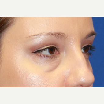 38 year old woman treated with Transconjunctival lower Eyelid Surgery, Fat transfer and CO2 laser before 3100500