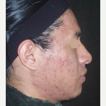18-24 year old man treated with TCA Peel after 3140223