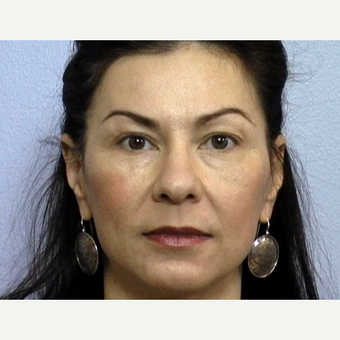 43 year old woman with stern facial expression due to lower eyelid "bags" and upper lid skin laxity before 3288432