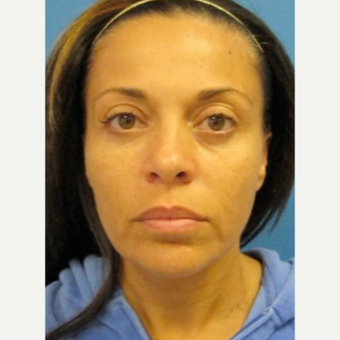 35-44 year old female treated with Lower Facelift before 2847871