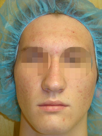 Acleara acne treatment with microextraction device after 1012034