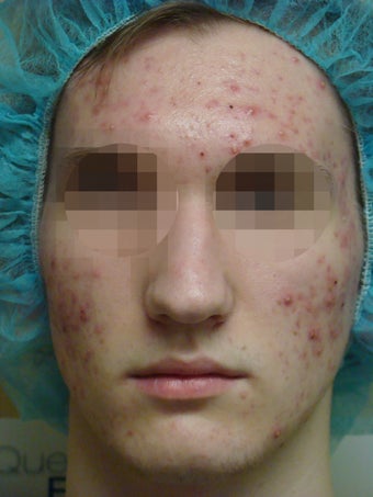 Acleara acne treatment with microextraction device before 1012034