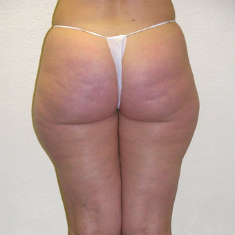 45 year old woman treated with Smart Lipo before 3684921