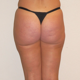 45 year old woman treated with Smart Lipo after 3684921