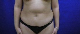 Tummy Tuck before 606501