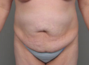 45-54 year old woman treated with Tummy Tuck before 3282386