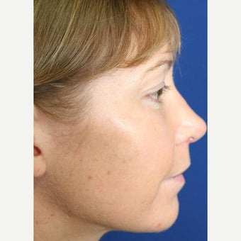 25-34 year old woman treated with Cheek Implants, Chin Implant, Nose Surgery and Fat Grafts 1950056