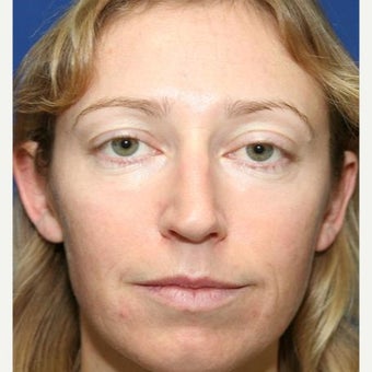 25-34 year old woman treated with Cheek Implants, Chin Implant, Nose Surgery and Fat Grafts after 1950056