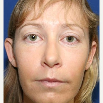 25-34 year old woman treated with Cheek Implants, Chin Implant, Nose Surgery and Fat Grafts before 1950056