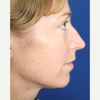 25-34 year old woman treated with Cheek Implants, Chin Implant, Nose Surgery and Fat Grafts 1950056