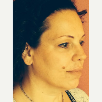 45-54 year old woman treated with Ultherapy before 3220493