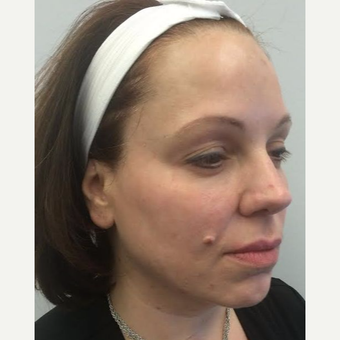 45-54 year old woman treated with Ultherapy after 3220493