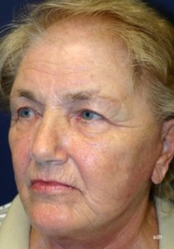 75 and up year old woman treated with Facelift after 1670001