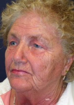 75 and up year old woman treated with Facelift before 1670001