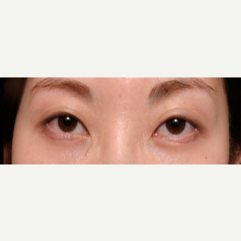 25-34 year old woman treated with Eye Bags Treatment after 3135562