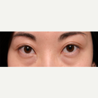 25-34 year old woman treated with Eye Bags Treatment before 3135562