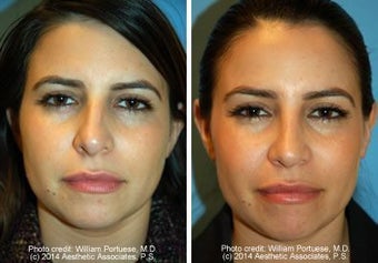 Rhinoplasty before 221419