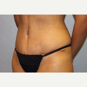 25-34 year old woman treated with Tummy Tuck after 3529350
