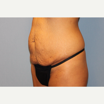 25-34 year old woman treated with Tummy Tuck before 3529350