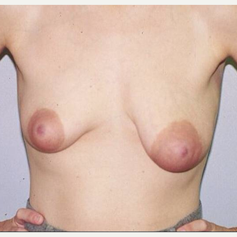 36 year old woman treated with Breast Lift before 3482537