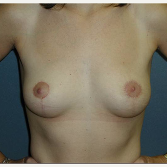 36 year old woman treated with Breast Lift after 3482537