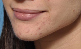 Microneedling for acne treatments after 1746388