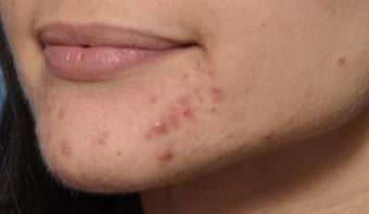 Microneedling for acne treatments before 1746388