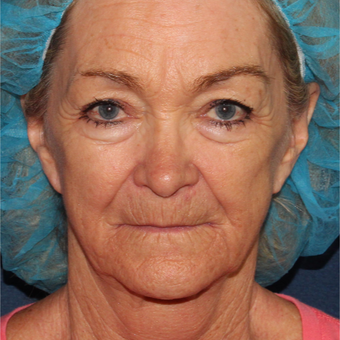 67 year old woman treated with CO2 and Erbium Laser Resurfacing before 3630302