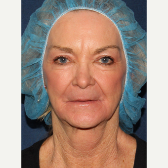 67 year old woman treated with CO2 and Erbium Laser Resurfacing after 3630302