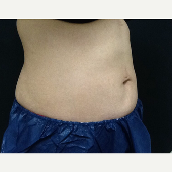 35-44 year old woman treated with CoolSculpting after 3382694