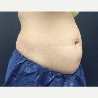 35-44 year old woman treated with CoolSculpting before 3382694