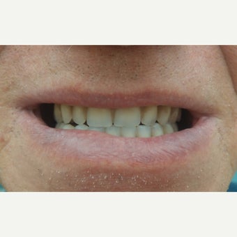 55-64 year old man treated with Dental Implants after 1797779