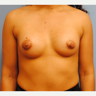 31 year old woman-submuscular 250 cc silicone implants - periareolar incision after 3077436