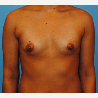 31 year old woman-submuscular 250 cc silicone implants - periareolar incision before 3077436