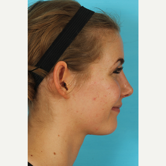 25-34 year old woman treated with Rhinoplasty after 3629395