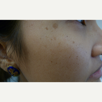 Picosure fractional laser for ethnic skin - Asian skin types before 3583835